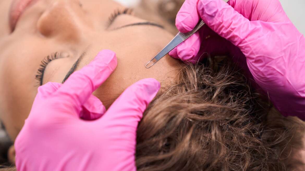 Dermaplaning